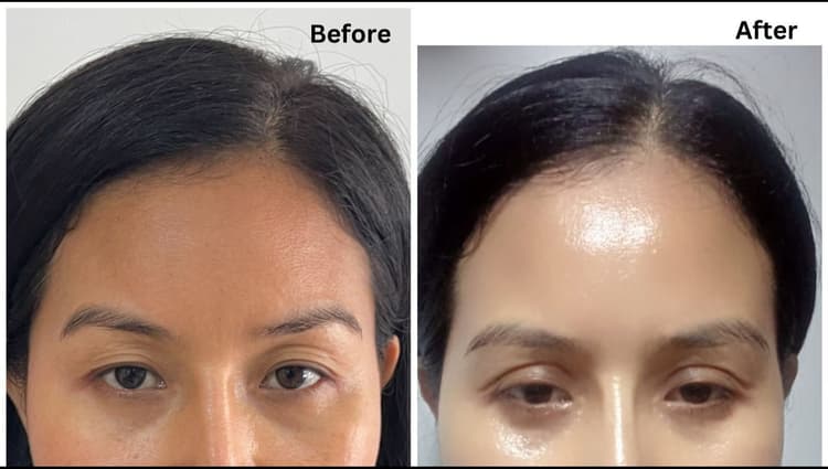 Blepharoplasty at adorn aesthetic clinic Ahmedabad