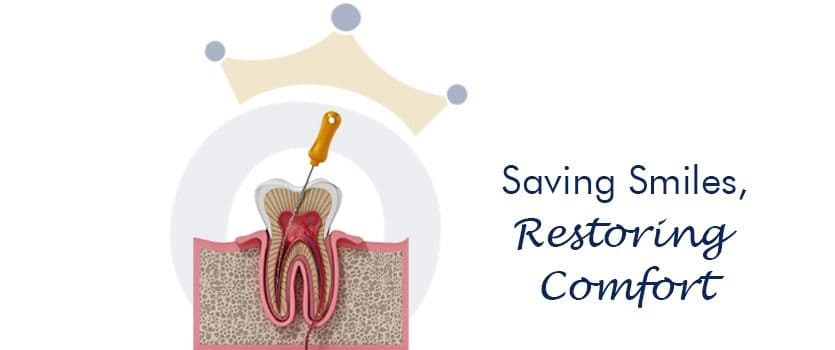 Root Canal Ahmedabad