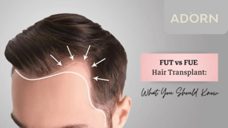 FUE vs. FUT: Which Hair Transplant Method Is Right for You? Fue vs Fut  hair transplant