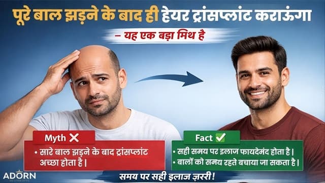 पूरे बाल झड़ जाने के बाद ही हेयर ट्रांसप्लांट कराऊंगा” – यह एक बड़ा मिथ है Hair transplant myths