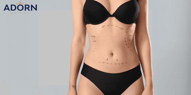 Liposuction in Ahmedabad: Cost, Procedure, & Recovery  Liposuction in Ahmedabad Cost